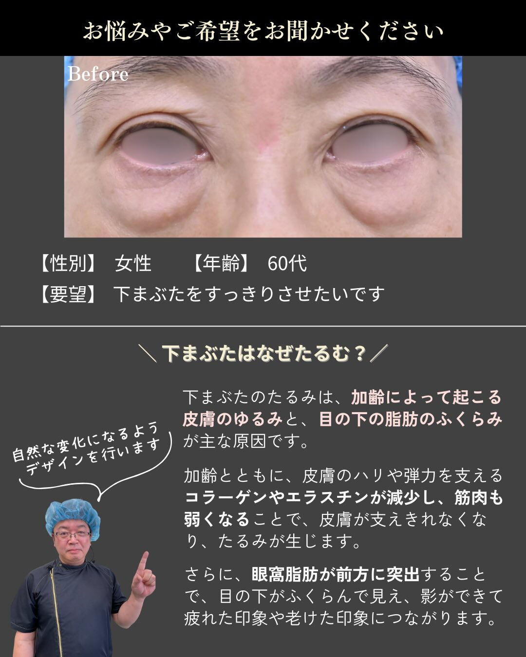 年齢とともに気になりやすい「下まぶたのたるみ・ふくらみ」