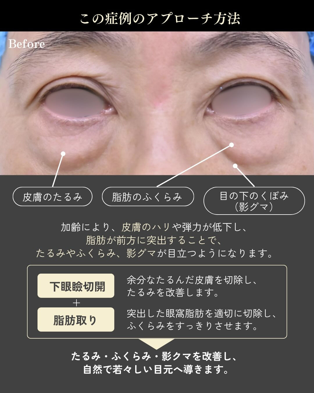 年齢とともに気になりやすい「下まぶたのたるみ・ふくらみ」
