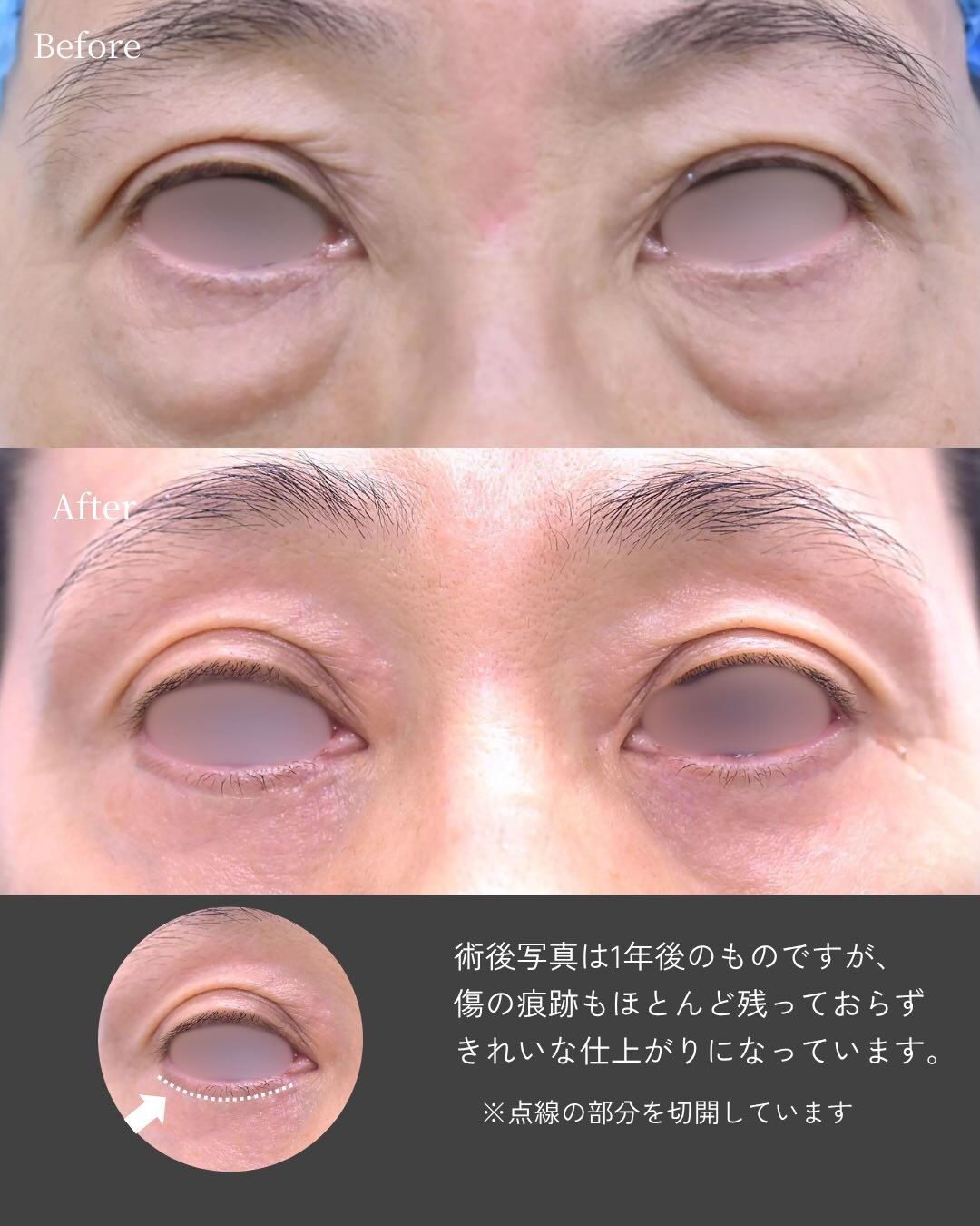 年齢とともに気になりやすい「下まぶたのたるみ・ふくらみ」