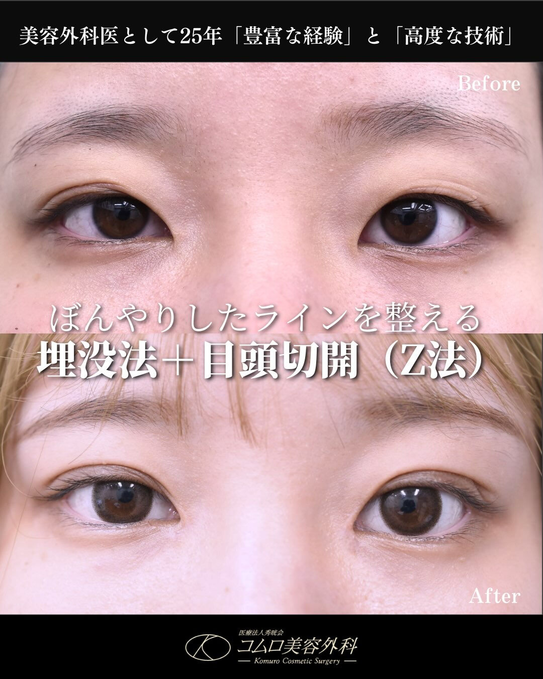 「アイテープを続ければ、自然な二重になる？」
