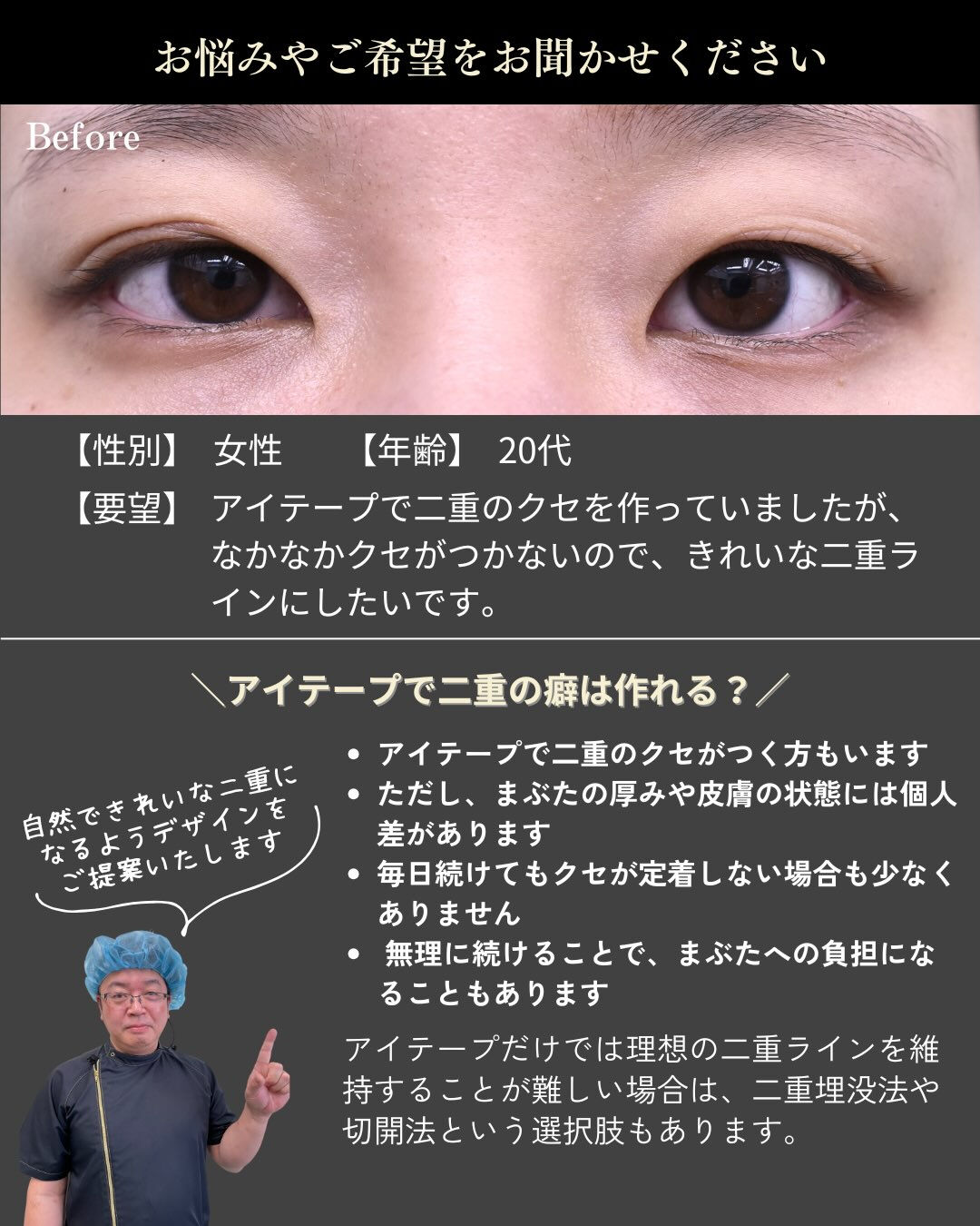 「アイテープを続ければ、自然な二重になる？」