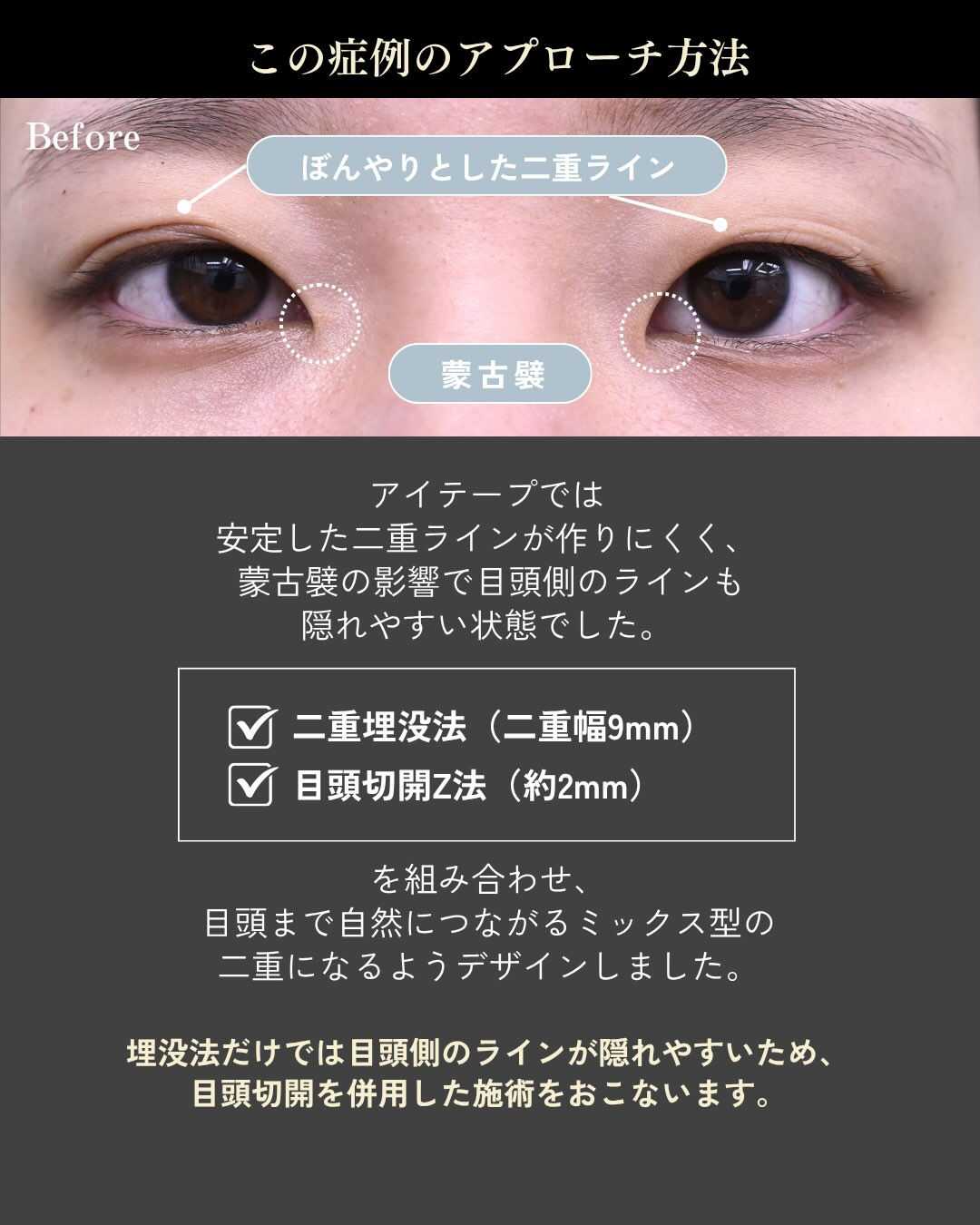 「アイテープを続ければ、自然な二重になる？」