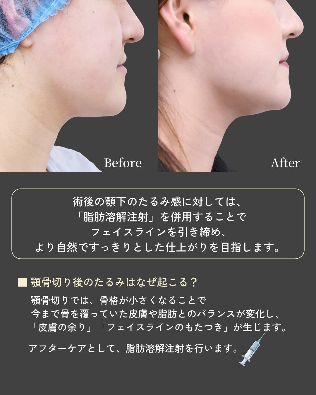 顎の長さや顔の大きさが気になる方へ