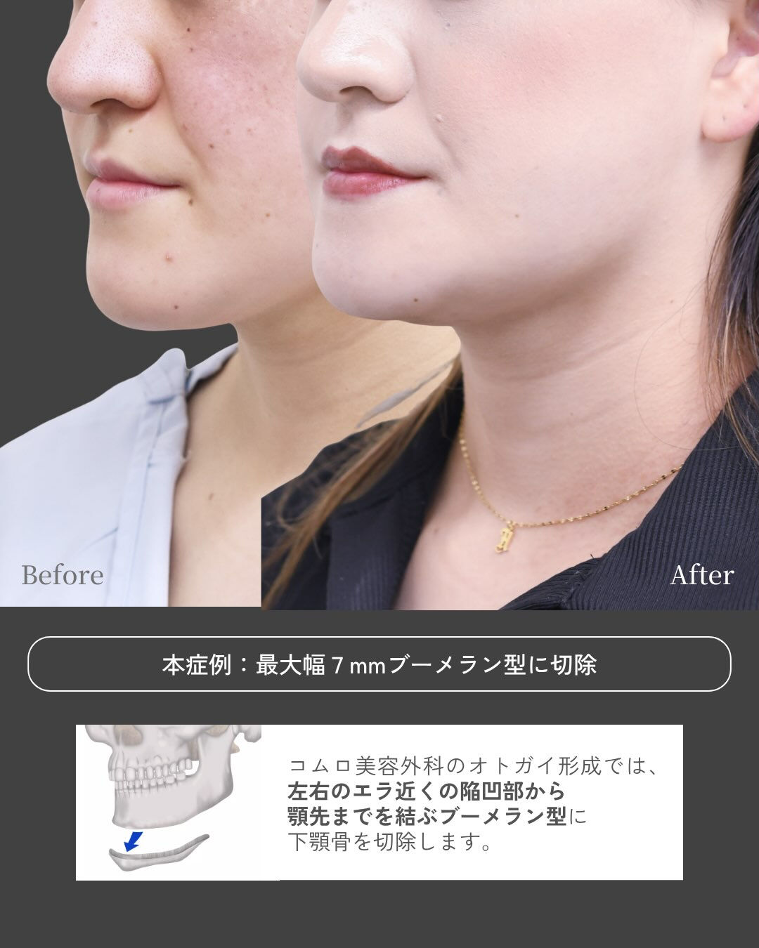 顎の長さや顔の大きさが気になる方へ