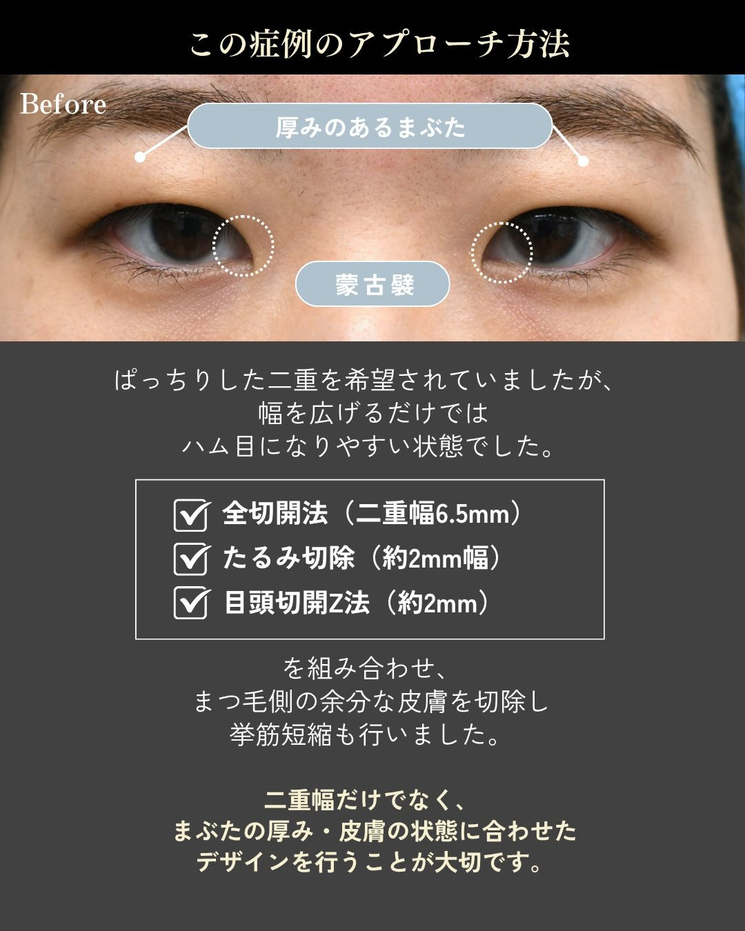 「二重幅を広げたい」