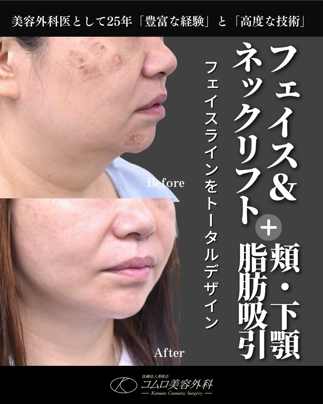 ✨フェイスリフト症例✨