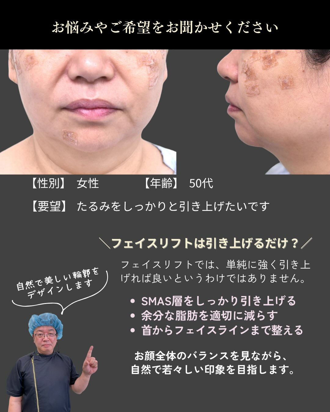 ✨フェイスリフト症例✨
