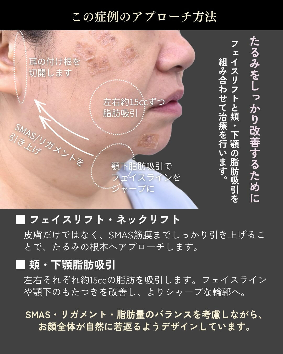 ✨フェイスリフト症例✨