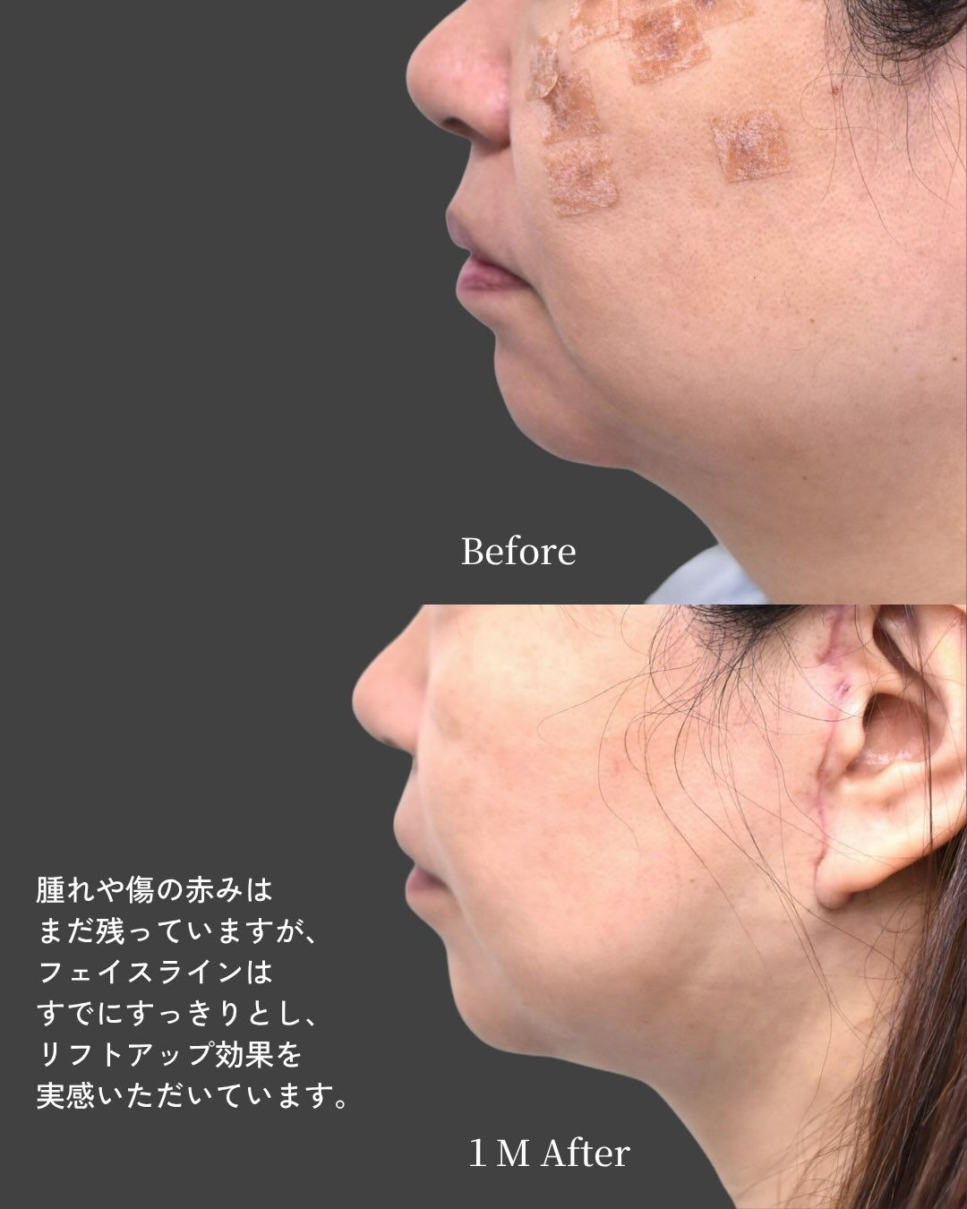 ✨フェイスリフト症例✨