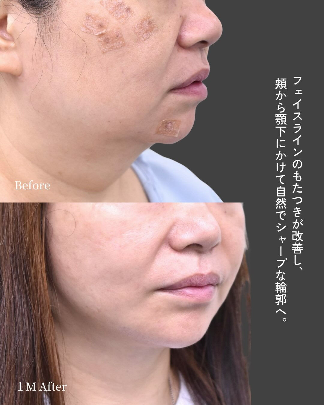 ✨フェイスリフト症例✨