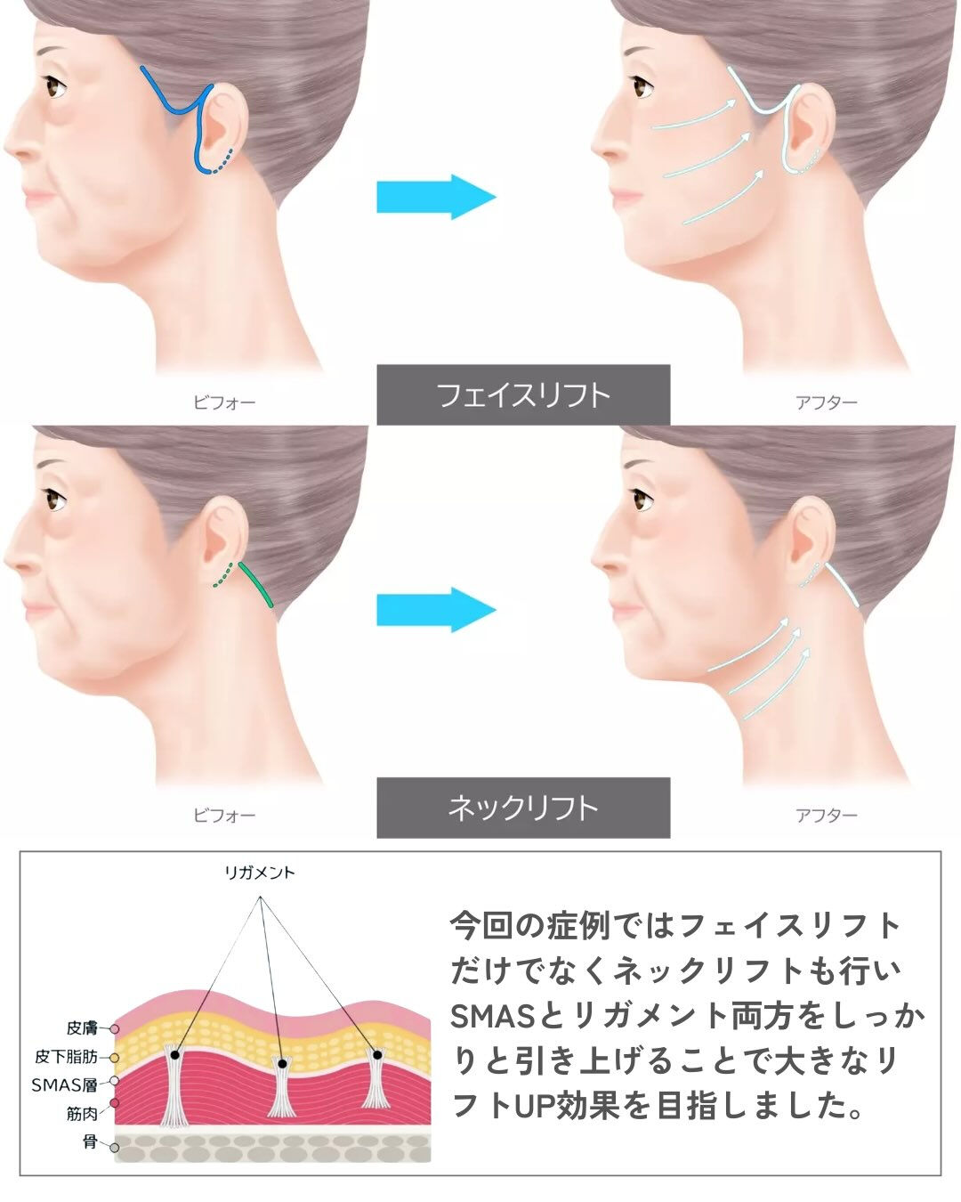 ✨フェイスリフト症例✨