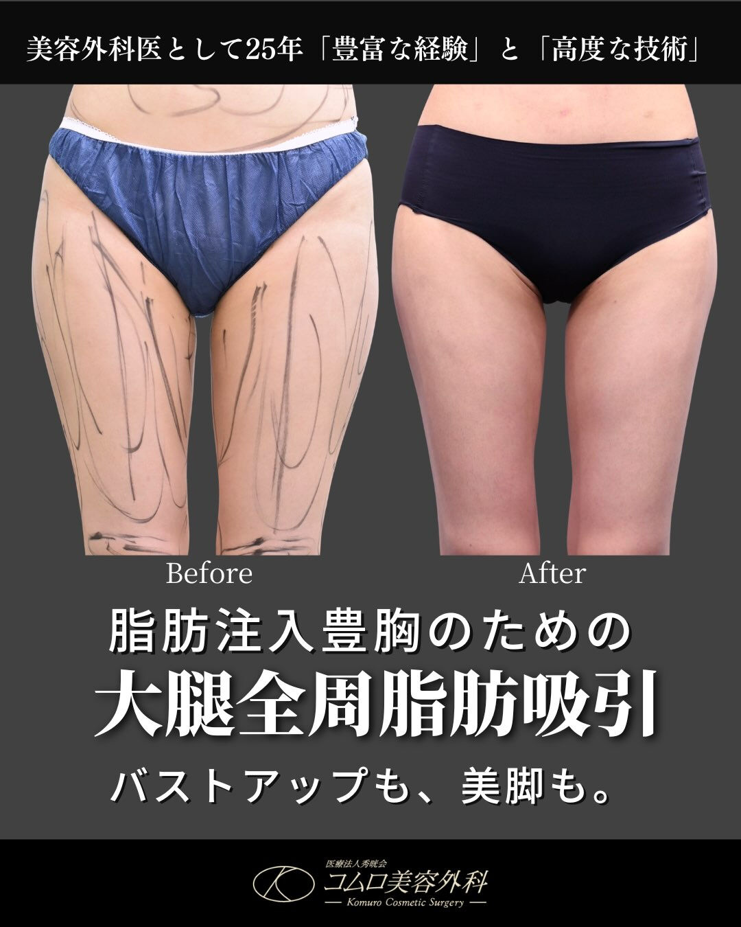 【脂肪注入豊胸のための大腿全周脂肪吸引】