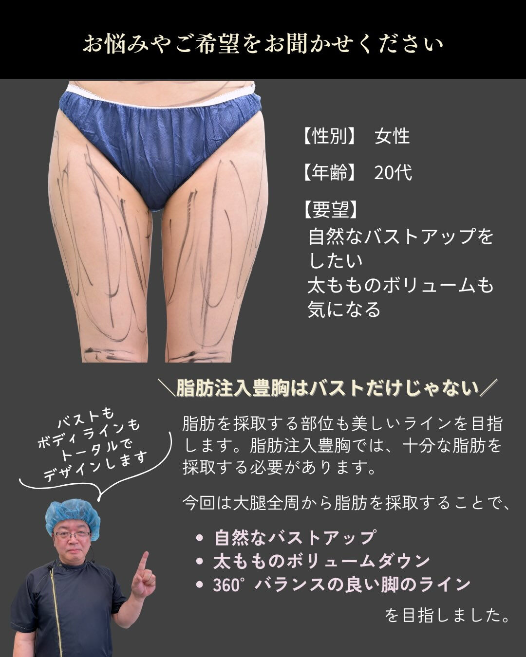 【脂肪注入豊胸のための大腿全周脂肪吸引】