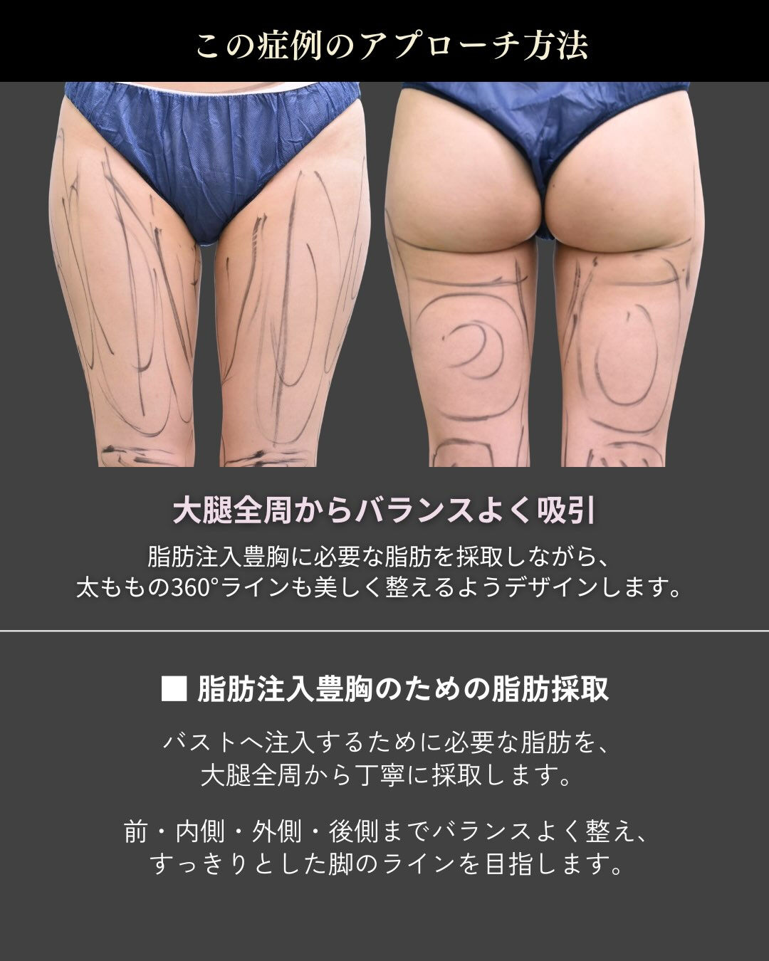 【脂肪注入豊胸のための大腿全周脂肪吸引】
