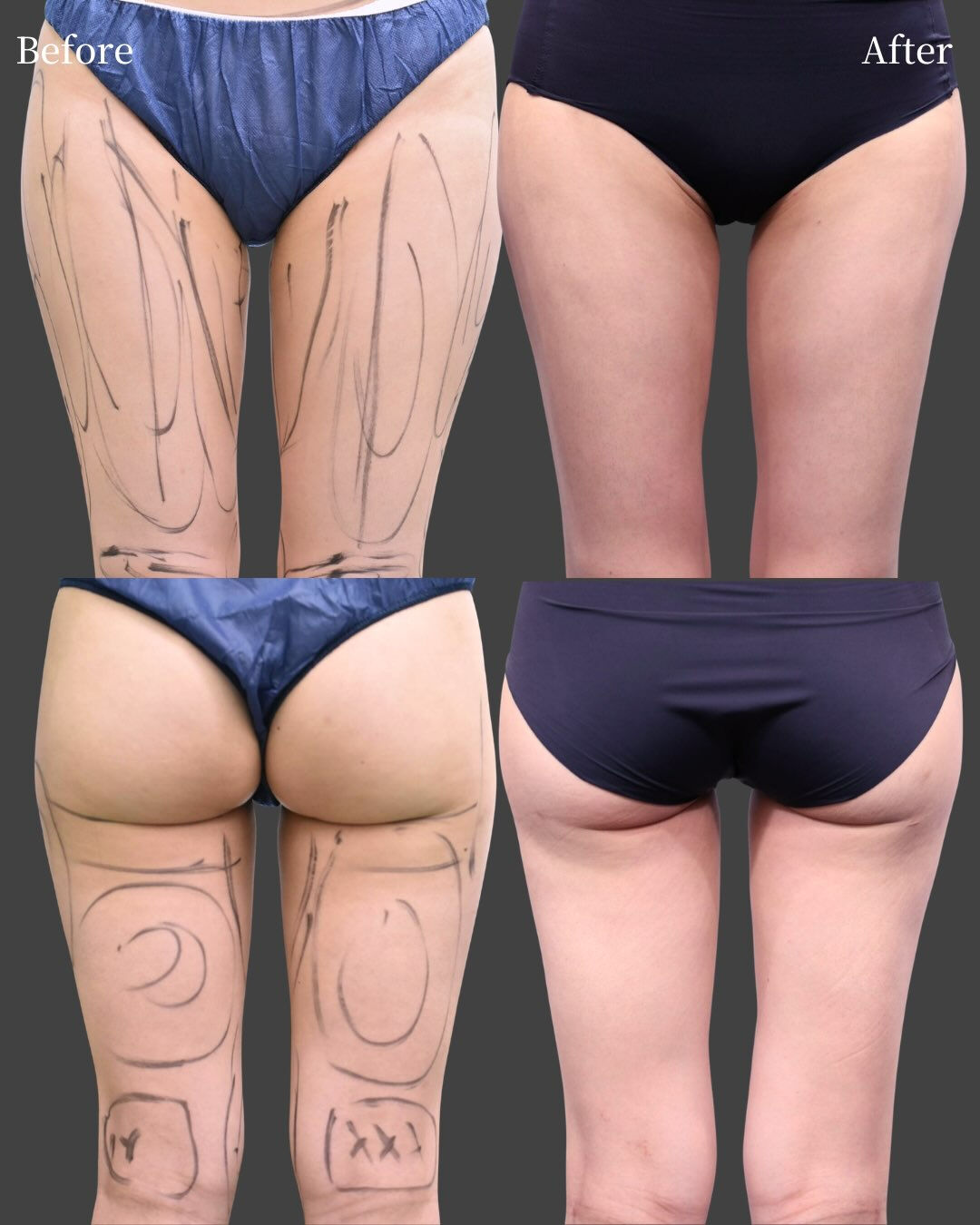 【脂肪注入豊胸のための大腿全周脂肪吸引】