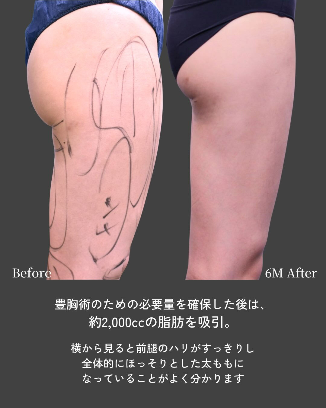 【脂肪注入豊胸のための大腿全周脂肪吸引】