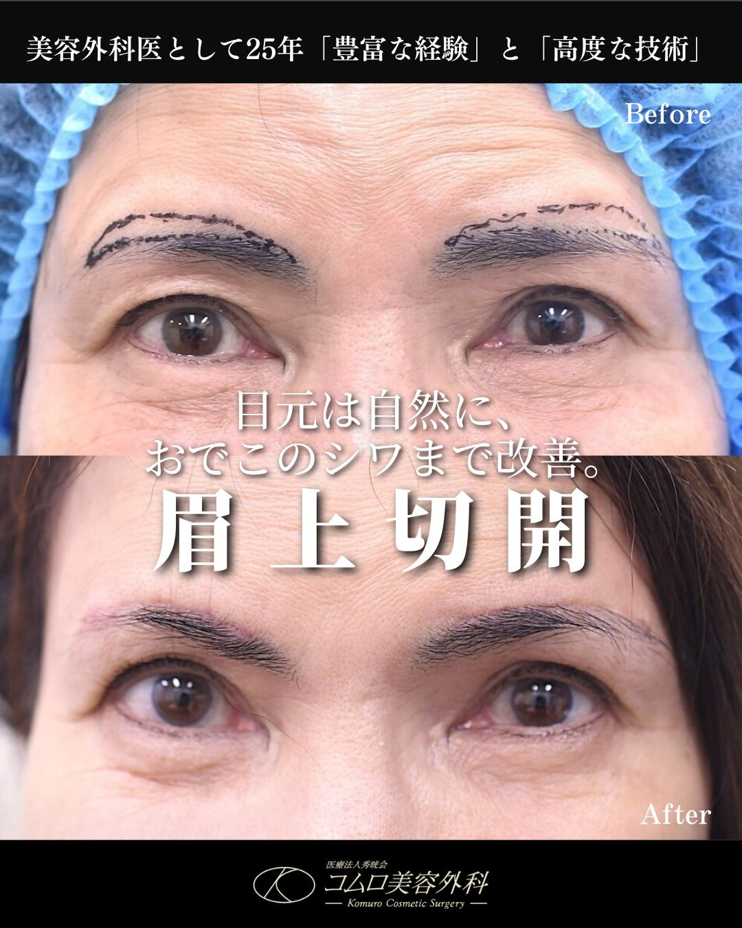 👀 目元は自然に、おでこのシワまで改善