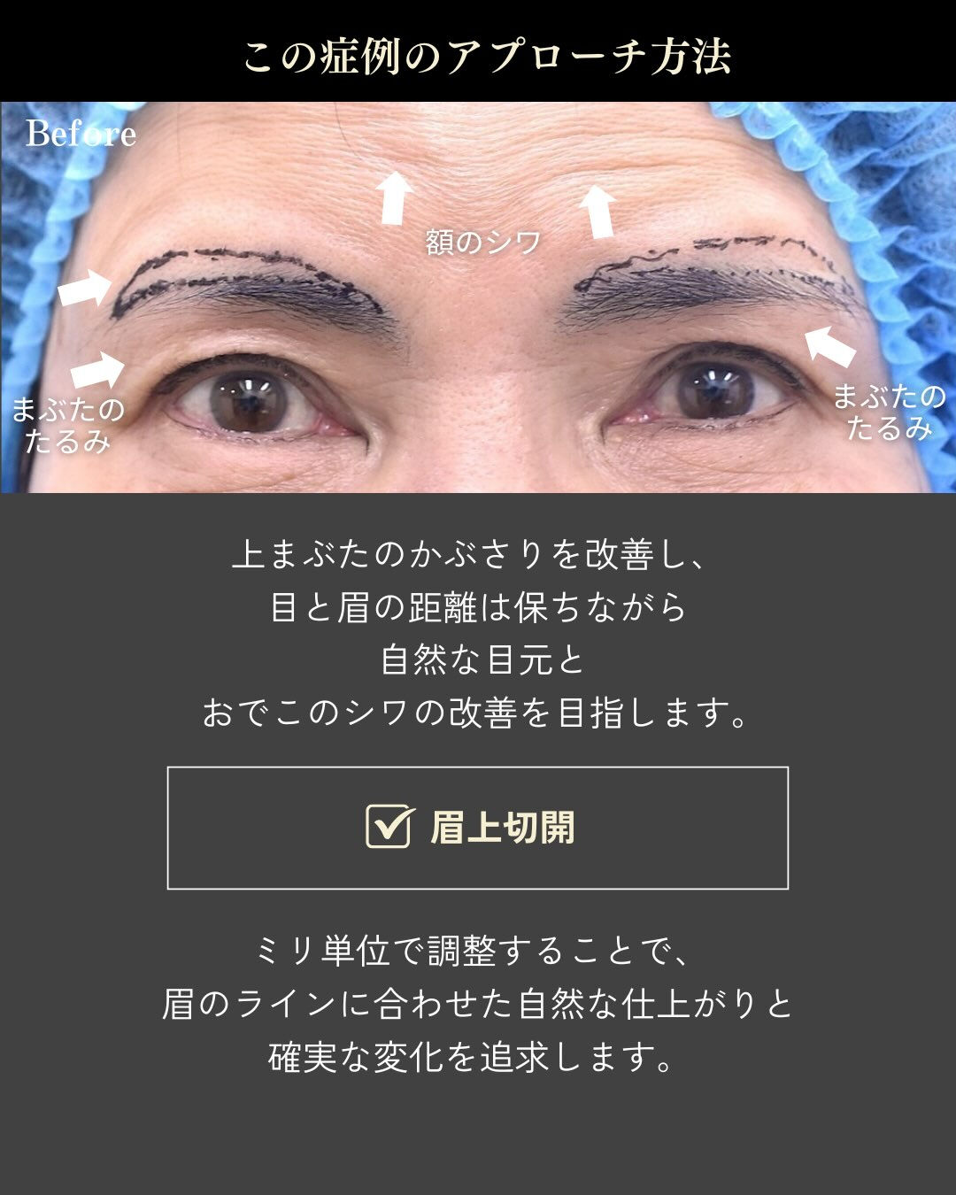 👀 目元は自然に、おでこのシワまで改善