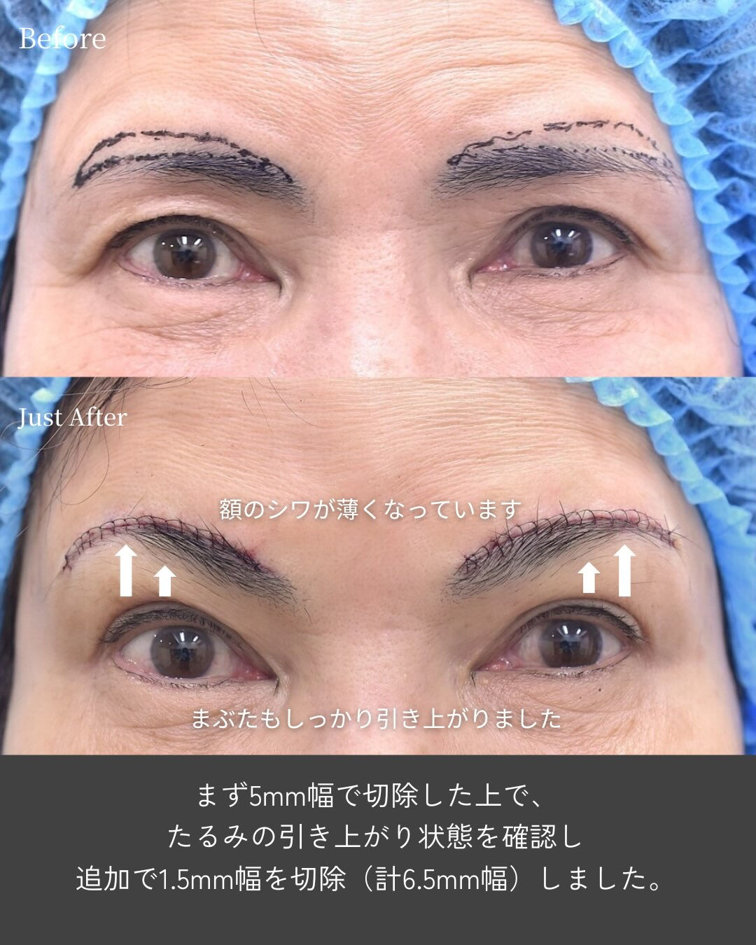 👀 目元は自然に、おでこのシワまで改善