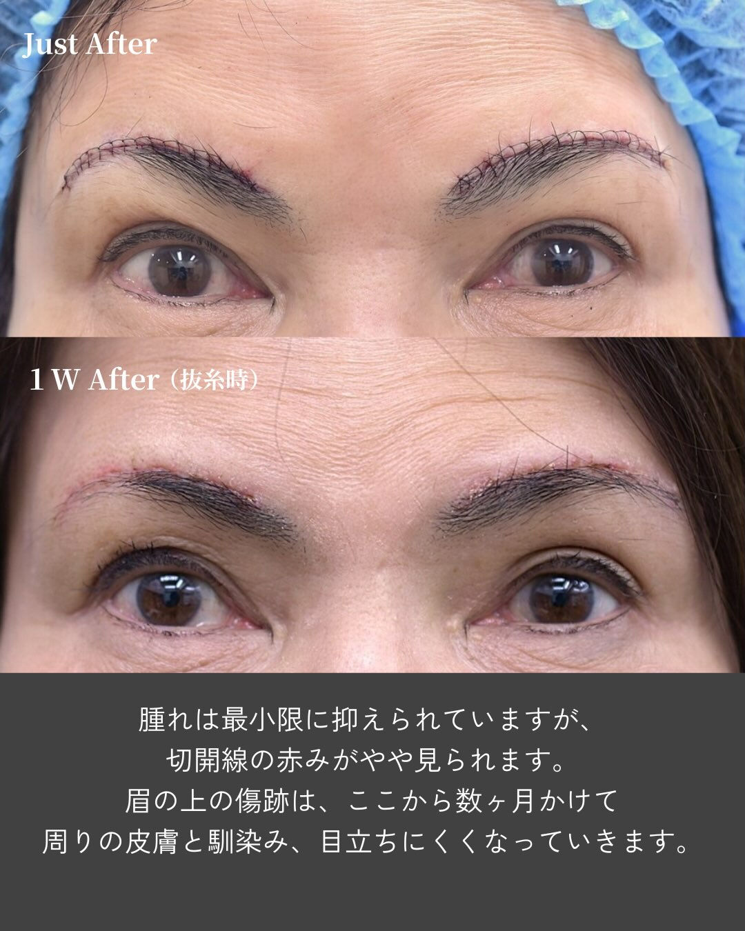 👀 目元は自然に、おでこのシワまで改善