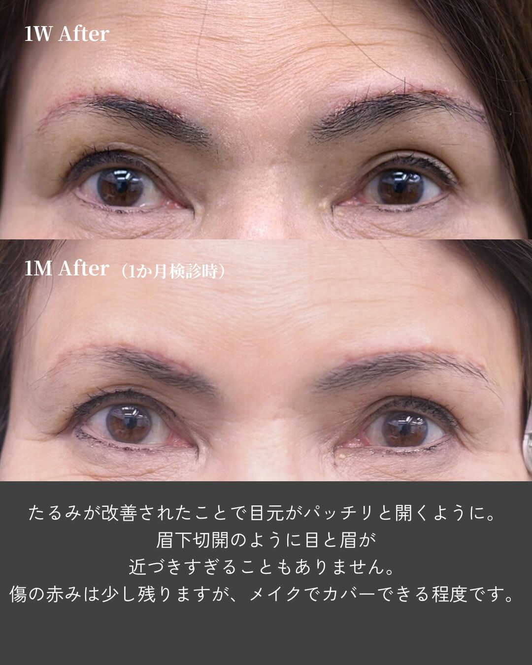 👀 目元は自然に、おでこのシワまで改善