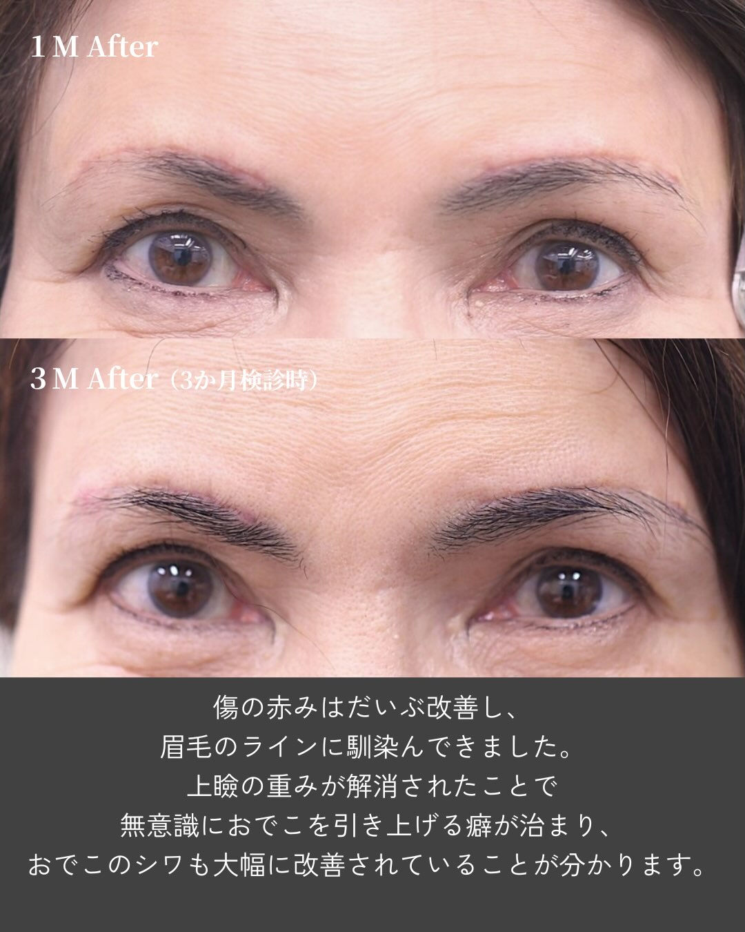 👀 目元は自然に、おでこのシワまで改善