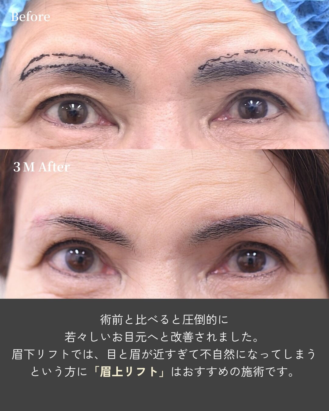 👀 目元は自然に、おでこのシワまで改善