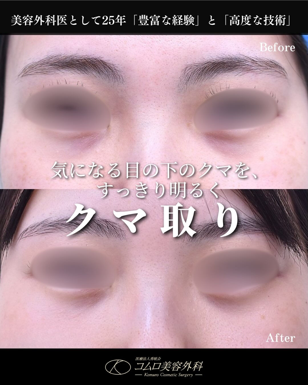 【20代女性｜クマ取り症例】