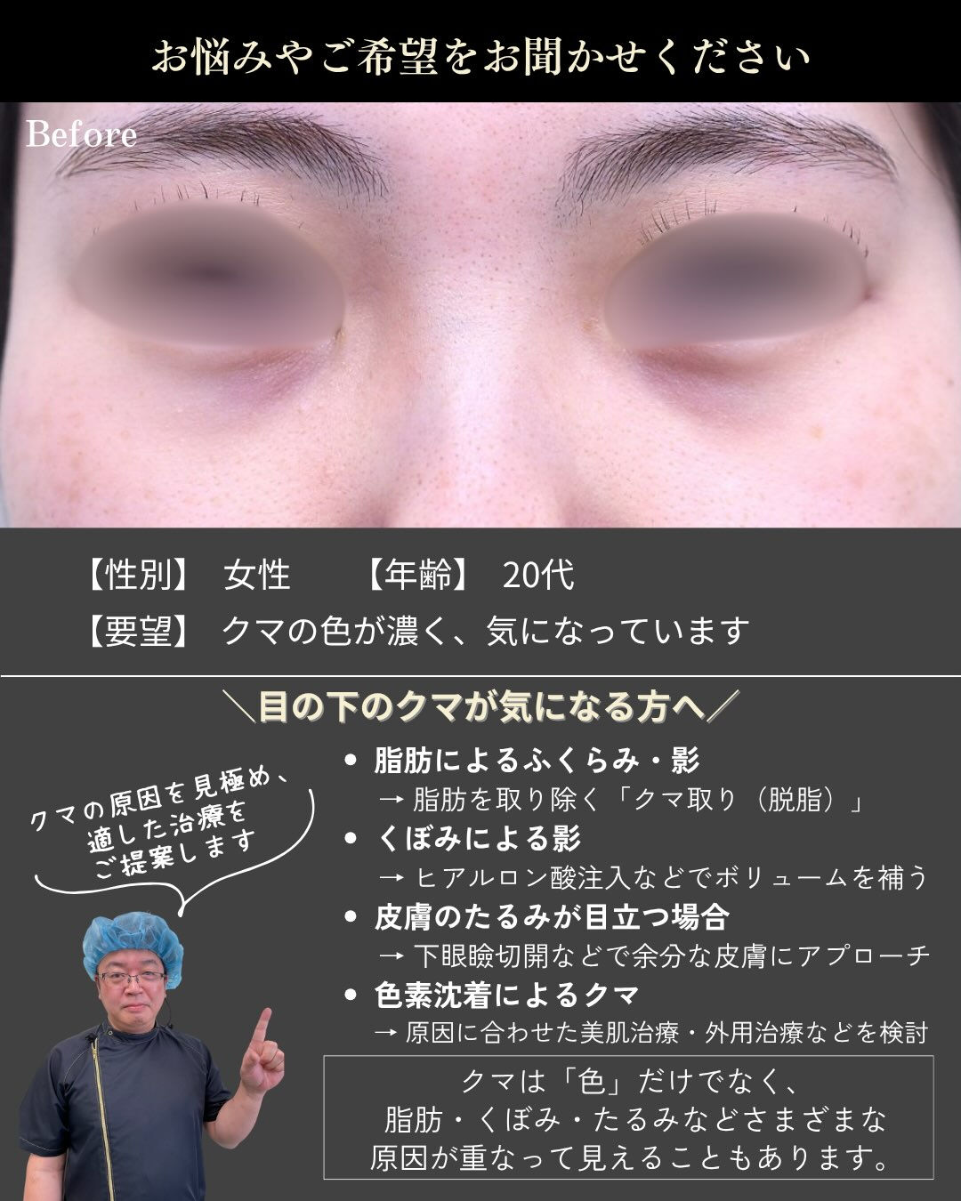 【20代女性｜クマ取り症例】
