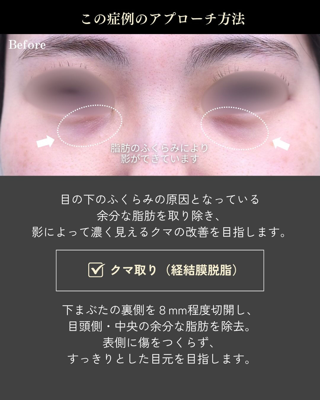 【20代女性｜クマ取り症例】