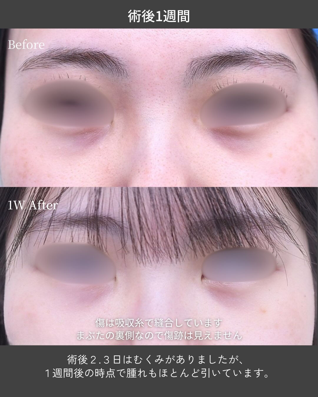 【20代女性｜クマ取り症例】