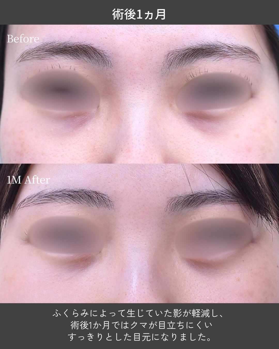 【20代女性｜クマ取り症例】